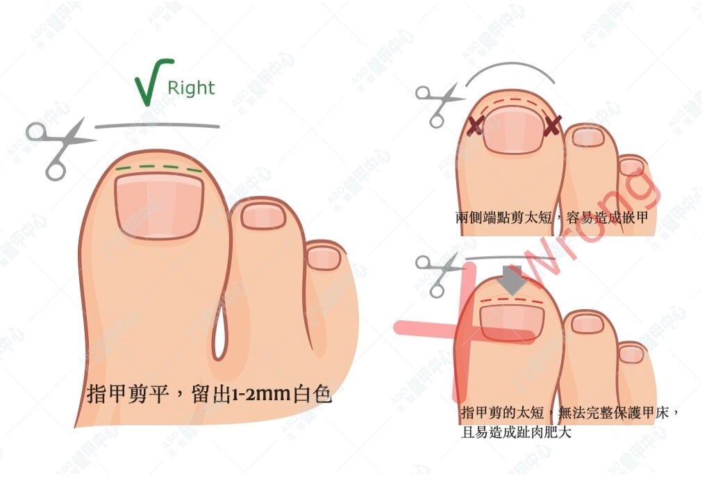 不要與人共用指甲剪或指甲銼，確保正確、仔細地剪指甲。