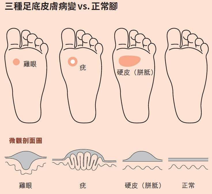 當腳趾頭一直往上拉，相對地蹠骨頭就會持續向下推，腳底壓力過大的時候，就會產生角質增生與疼痛現象。表面上看起來它的症狀與雞眼或疣很像，但其實一旦發生蹠痛，病患的骨頭可能早就已經脫臼了，卻不自知。