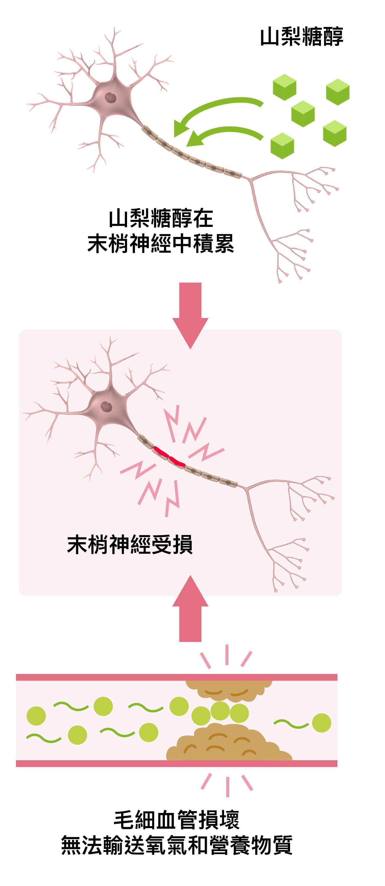 糖尿病神經病變發生原因,末梢神經受損
