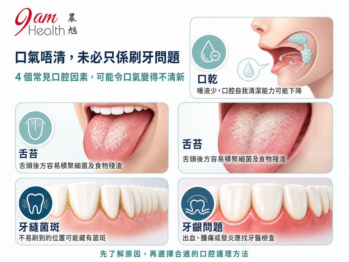 口氣危機成因資訊圖,列出口乾、舌苔、牙縫菌斑及牙齦問題四個可能因素