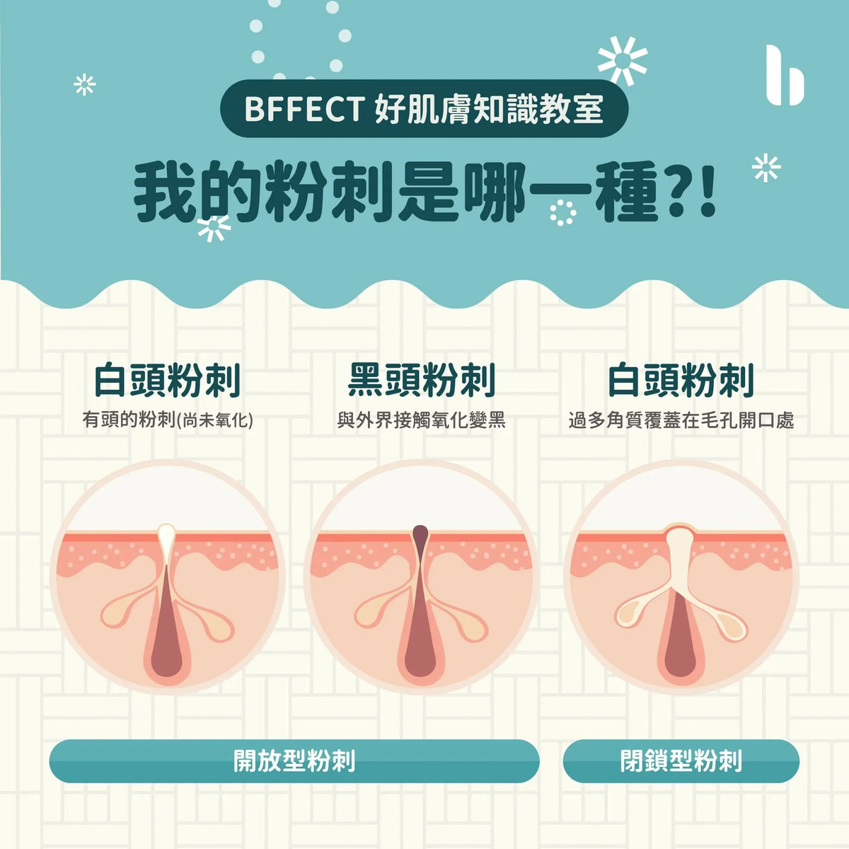 【BFFECT小教室】精準打擊惱人粉刺,選對酸類很重要
