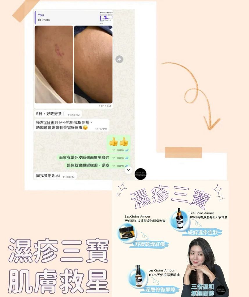 濕疹三寶R945仙人掌籽油+黑籽油+濕疹軟膏
