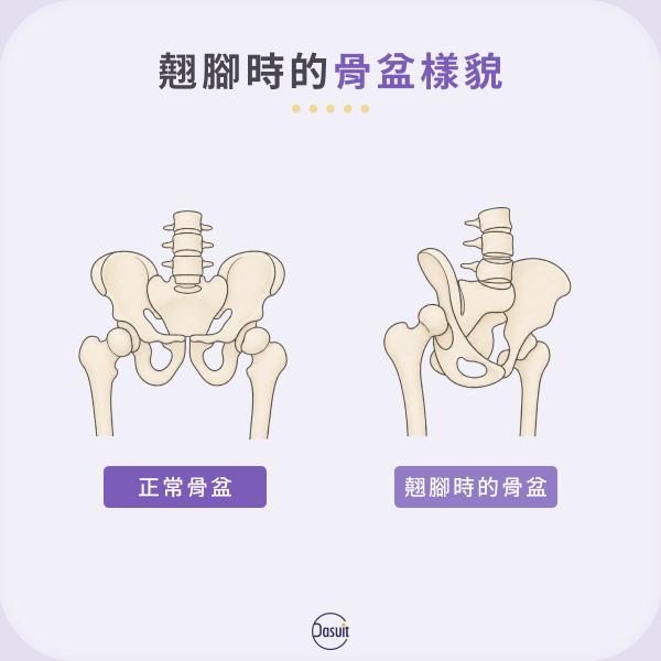 翹腳時的骨盆樣貌