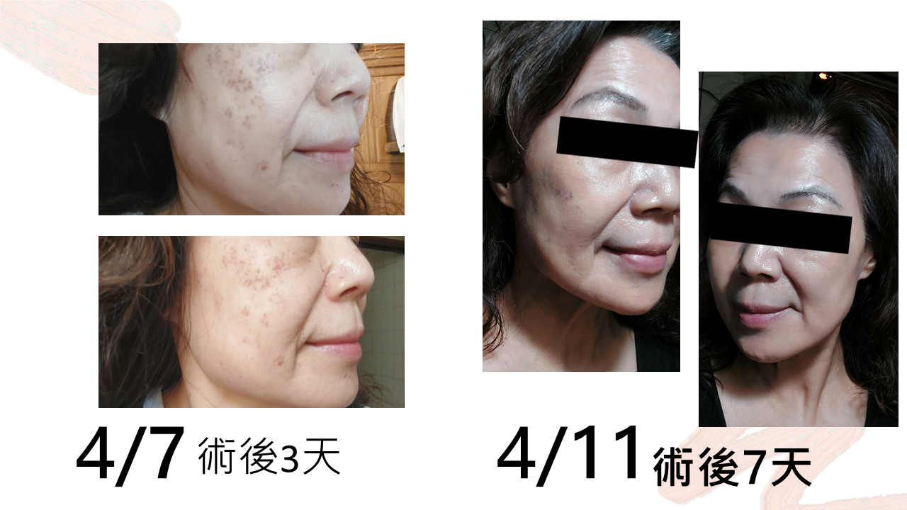 YUKI醫美術後使用臻奇肌保養的肌膚紀錄，4月7日術後3天與4月11日術後7天臉部膚況對照。