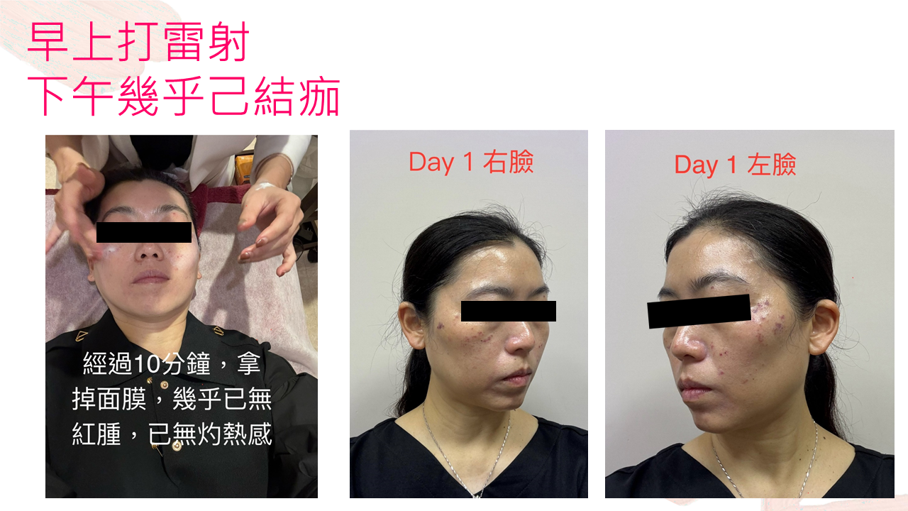 Emily雷射術後肌膚紀錄，術後第1天右臉與左臉膚況，以及療程後10分鐘肌膚狀態。