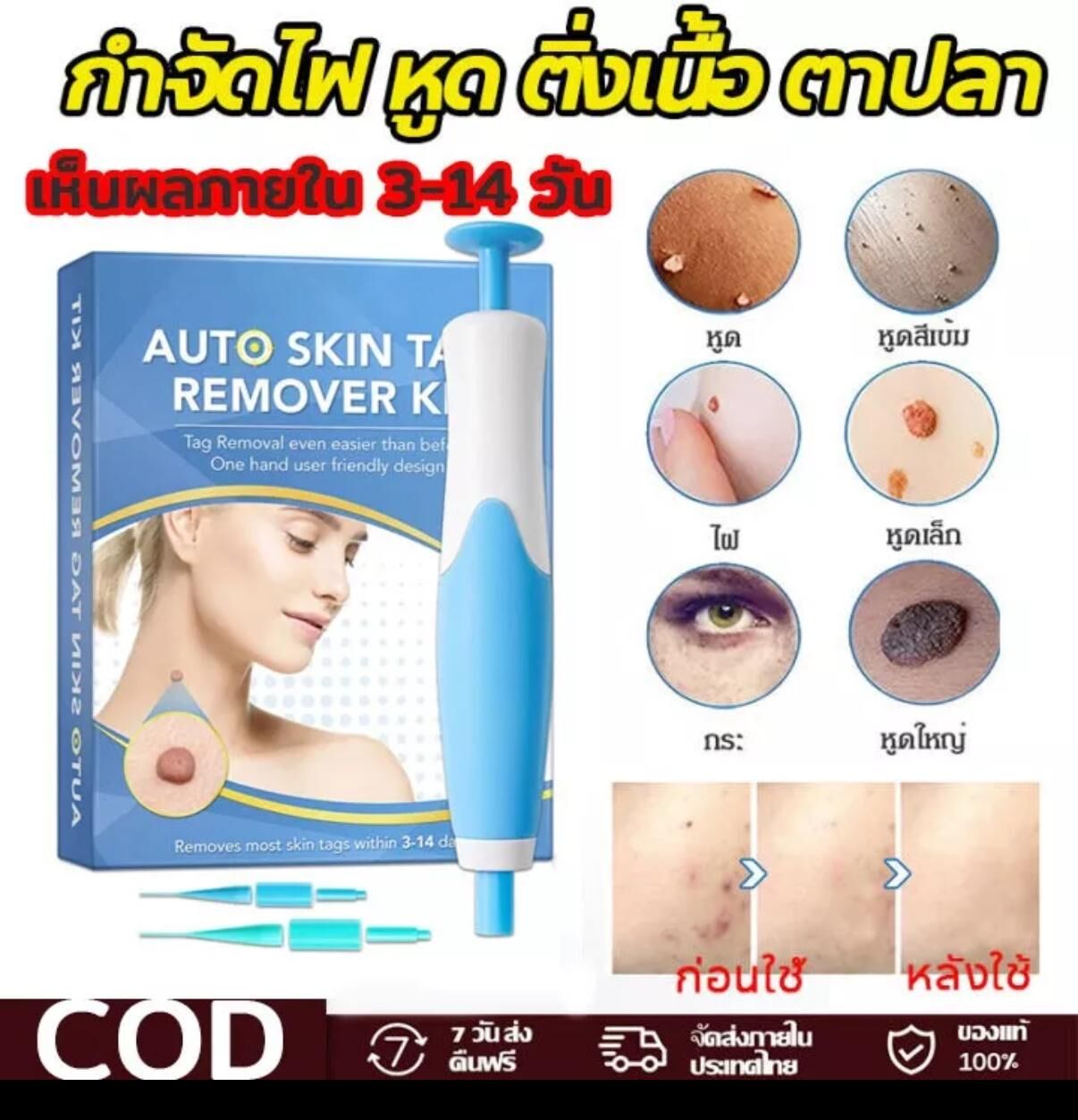 泰國 Auto Skin Tag Remover Kit自動除肉粒套裝