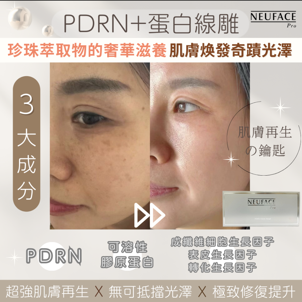 Neuface pro PDRN+蛋白線雕