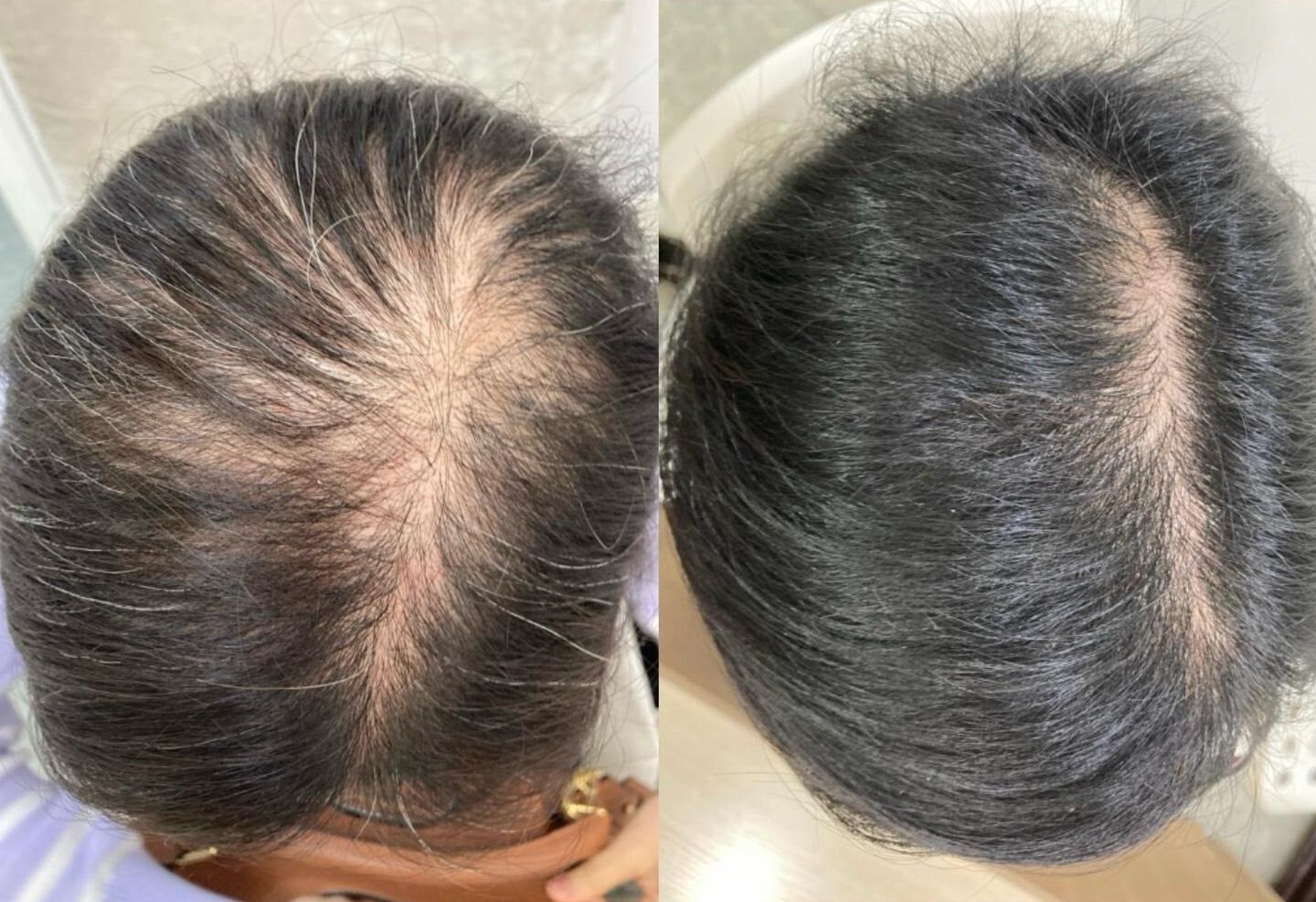0922NH05-NOBEL-HAIR-髮之生長因子-防敏配方 (1倍濃縮度) 30ml/支 [買3送1 平均$673.5／支] (A5)