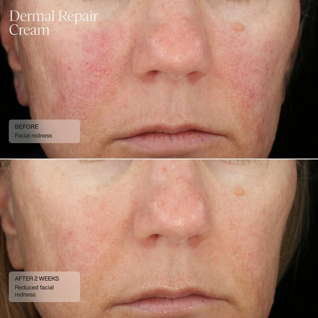 美國 Senté Dermal Repair Cream 50ml【正品  】醣美級修護保濕面霜  敏感肌 泛紅肌 酒糟傾向肌 屏障修護 深層保濕