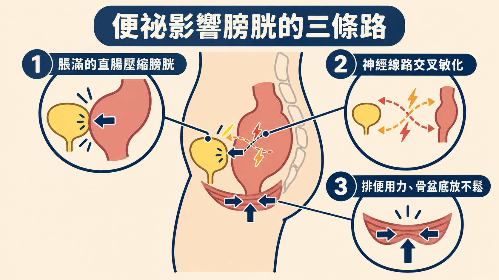 便祕影響膀胱的三條路:脹滿的直腸壓縮膀胱、神經線路交叉敏化、排便用力與骨盆底放不鬆