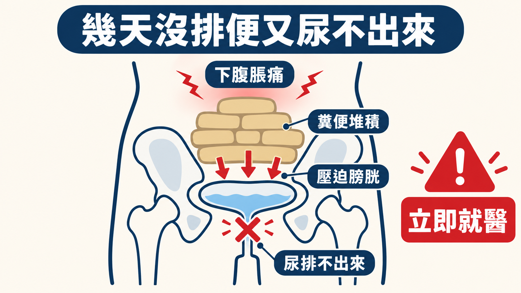 幾天沒排便又尿不出來:糞便堆積壓迫膀胱,尿排不出來、下腹脹痛要立即就醫