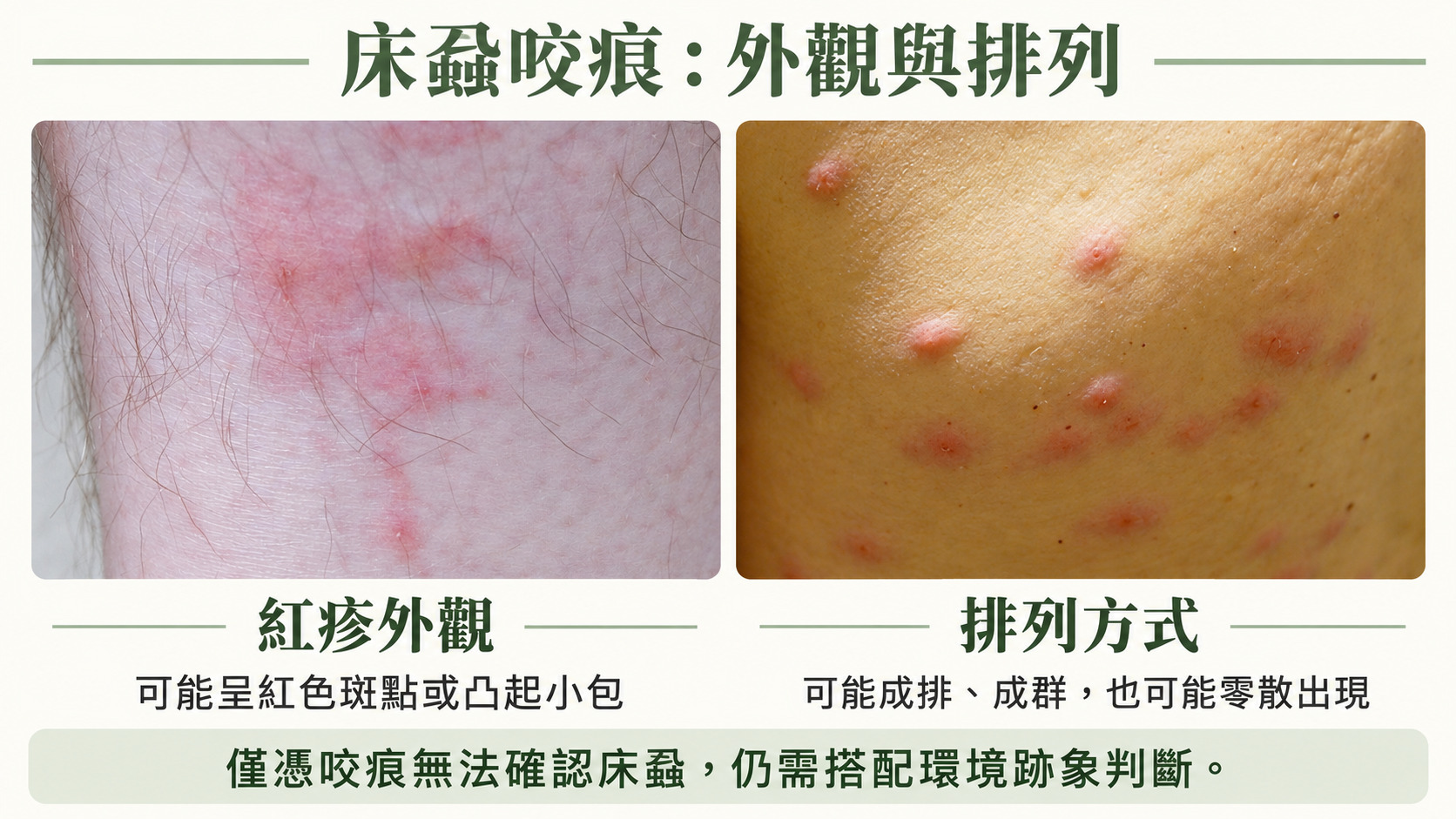床蝨咬痕辨識指南