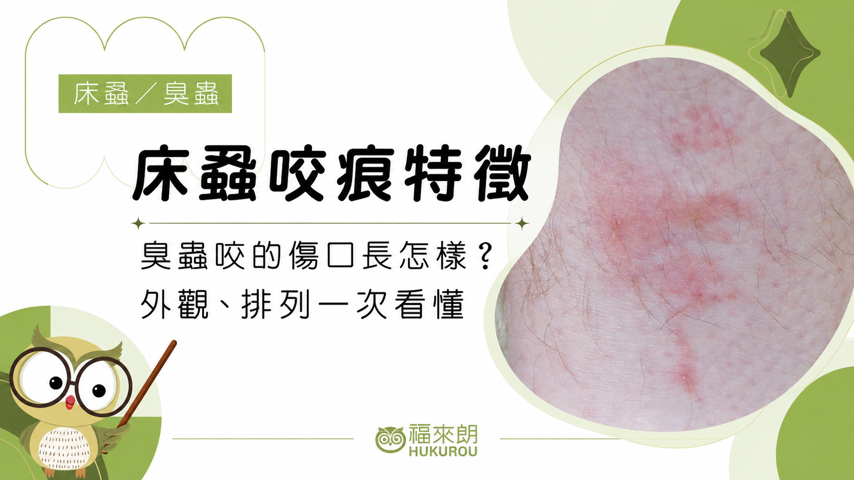 床蝨傷口與咬痕特徵的辨識資訊